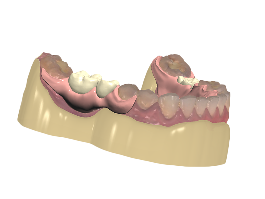 Impress3D Digital Valplast® Partial Dentures for Dentists and Patients